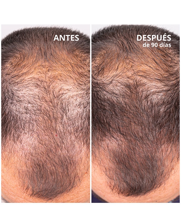 HAIR GROWTH & DENSITY TREATMENT